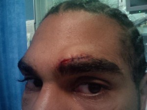 David Haye cut